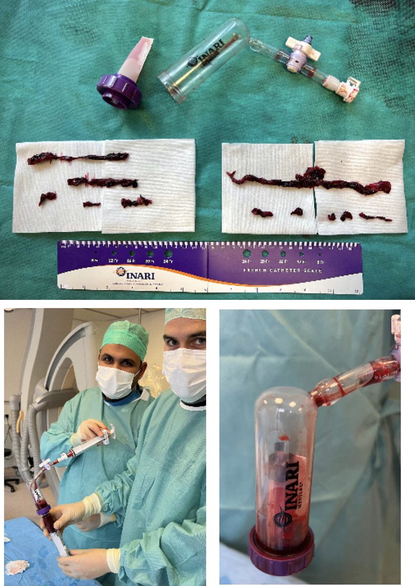 melsharabasssy's tweet photo. I’m glad to announce that the first case with the novel #flow_saver in the #EMEA region was performed today in our center... a new Era in the treatment of acute PE, not only lytic-free, but also without significant blood loss (today‘s case about 60 ml). https://t.co/NnDvulg7JL