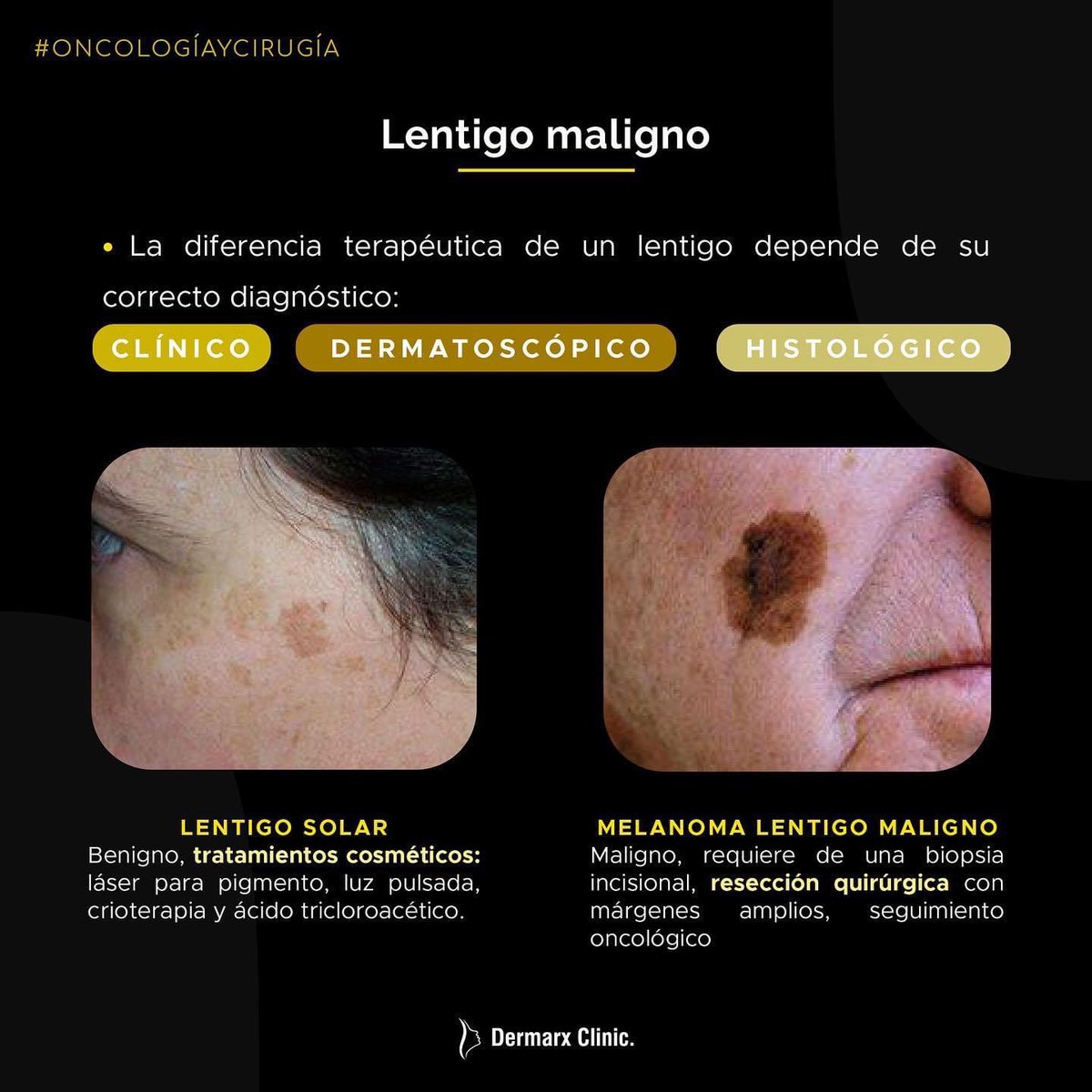 dermarxclinic's tweet photo. Los léntigos solares suelen ser una causa muy frecuente de consulta cosmética en dermatología.
#lentigo #lentigosolar #lentigomaligno #melanoma #skincancer #cancerdepiel #oncoderma #dermatologia #dermatology #dermacdmx #dermatologocertificado https://t.co/0kNo141INZ