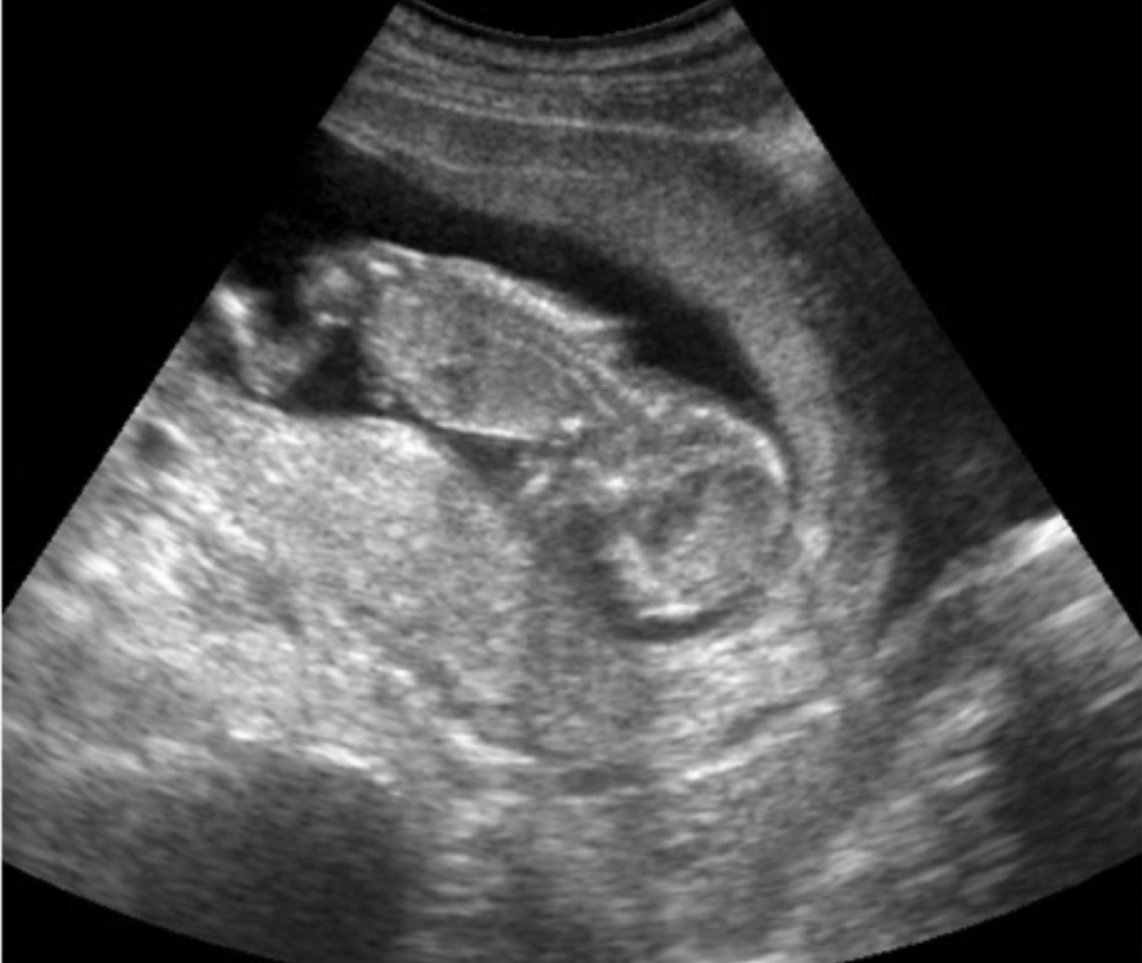 SaldenMark's tweet image. "Experten" pleiten voor een versoepeling van de #abortuswetgeving. Ze willen het optrekken naar 18 weken en de #Vivaldi-partijen, met uitzondering van #cdenv, zijn voorstander.