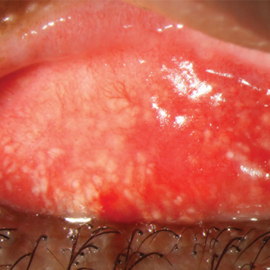 aao_ophth's tweet photo. Learn more about #conjunctival concretions and what to do if the patient is symptomatic. Section 8 of the #BCSC covers the structure and function of the #cornea and the external #eye, plus external disease. Focus on what matters. Purchase the BCSC today. https://t.co/PPnhXyeQ9G https://t.co/yrFjwUXKYH