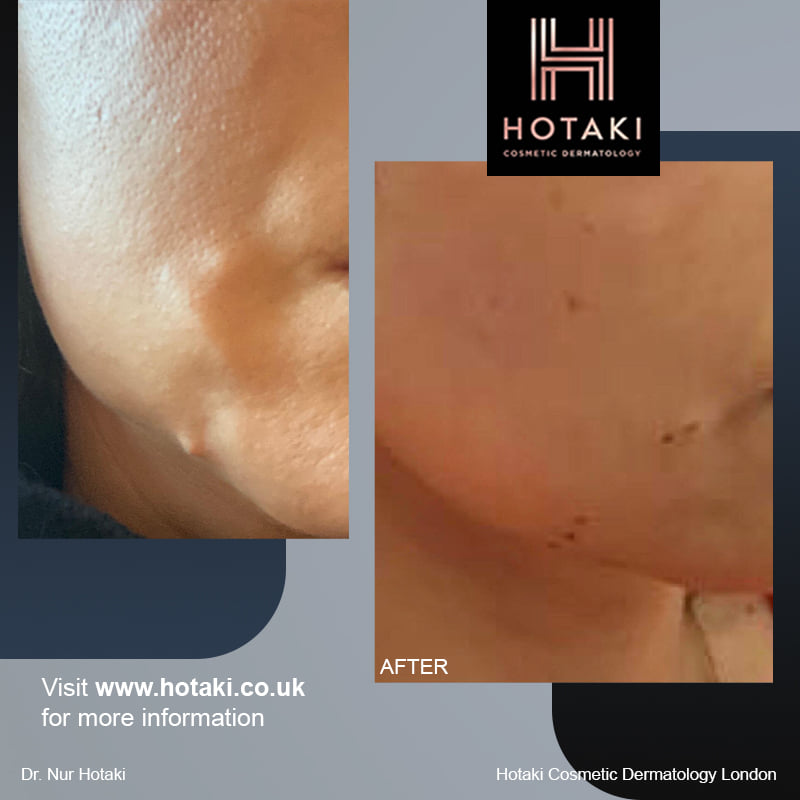 ClinicHotaki's tweet photo. #DrHotaki #hotakilondon #dermalfillers #antiageing #saggyskin #necklift #skinrejuvenation #wrinklyhands #bestdermatologistlondon #londondermatologist #cosmeticdermatologist #fatdissolvinginjections https://t.co/1asZaEiqXG