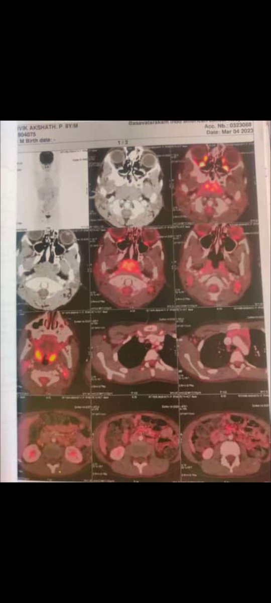 ravite's tweet photo. Ritvik is the son of my sister.
Rithvik used to be a very active kid but his Cancer has turned their family upside down.
They need help to afford his treatment as they are a middle-class family.
A/C NO. 006901593420
IFSC NO. ICIC0000040
Gpay or Phonepe no. 7093448767
Donate here https://t.co/66c7xKWvHb