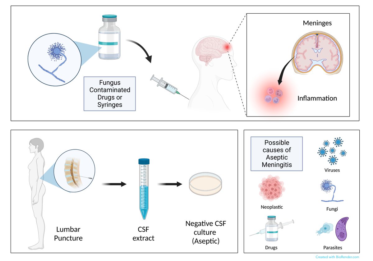 Vinay_Neuro's tweet photo. Nosocomial outbreaks of aseptic meningitis increase the risk of mortality in post-op patients. Our article published in the @IJSurgery (Impact factor: 13.4) highlights an incident of drug contamination with a fungus that led to the death of over 9 people

https://t.co/6zYQhbFA60 https://t.co/KoY3mlJH5Q