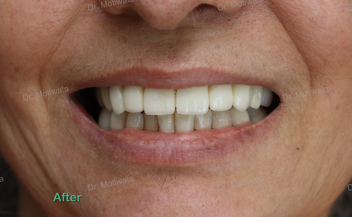 drmotiwaladcic's tweet image. Full upper arch #zirconiabridge including bite raise.
A patient from USA came with supra-erupted #teeth 
Treatment included placement of single piece #basalimplants on the upper arch and placement of zirconia crowns on the #upperteeth and lower back teeth for raising the bite.