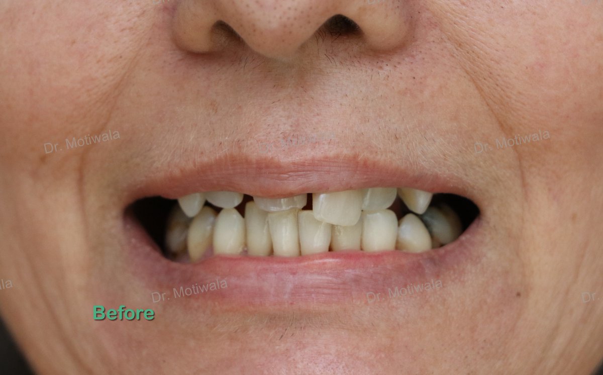 drmotiwaladcic's tweet image. Full upper arch #zirconiabridge including bite raise.
A patient from USA came with supra-erupted #teeth 
Treatment included placement of single piece #basalimplants on the upper arch and placement of zirconia crowns on the #upperteeth and lower back teeth for raising the bite.