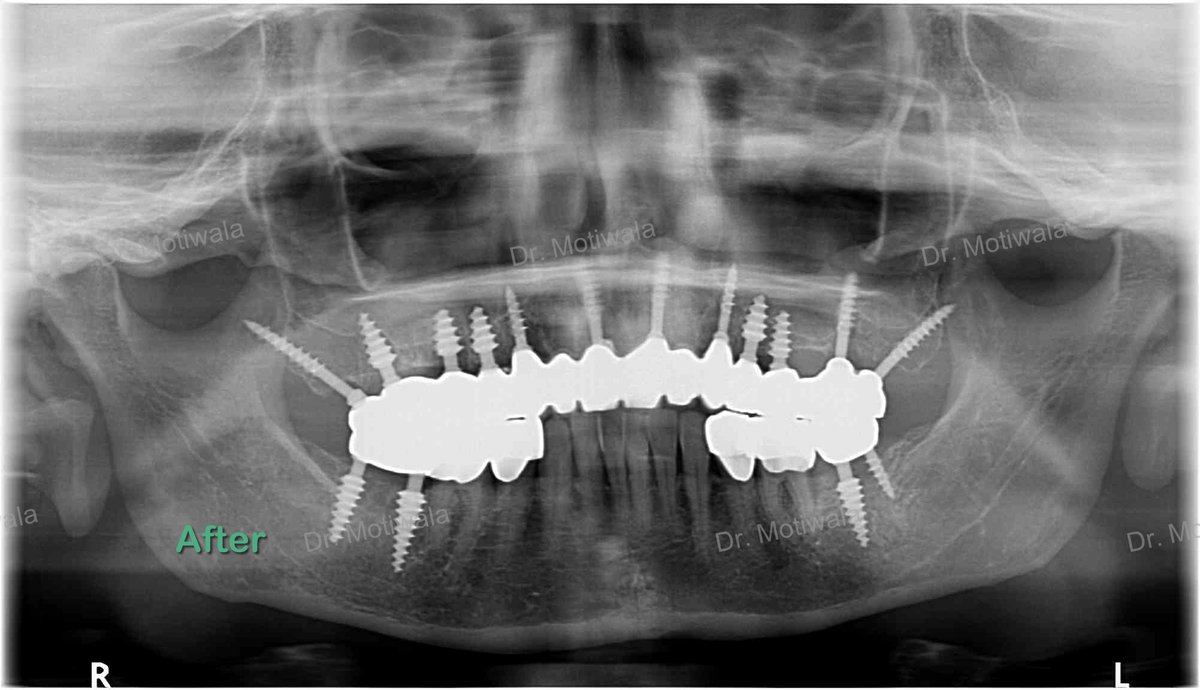 drmotiwaladcic's tweet image. Full upper arch #zirconiabridge including bite raise.
A patient from USA came with supra-erupted #teeth 
Treatment included placement of single piece #basalimplants on the upper arch and placement of zirconia crowns on the #upperteeth and lower back teeth for raising the bite.