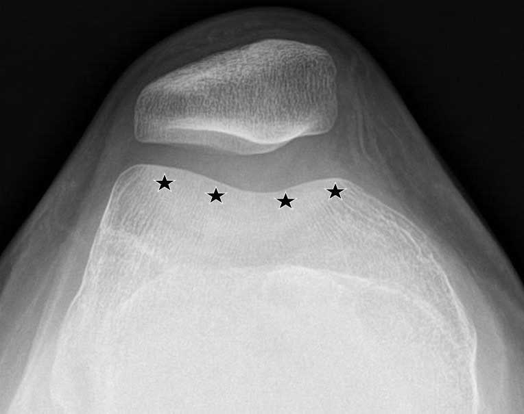 thekneedoc's tweet photo. How is #trochlear #dysplasia diagnosed on x-rays?
#TrochlearDysplasia is best diagnosed on both a 45-degree patella sunrise view and also on the lateral x-rays. In addition...https://t.co/9NnAPZTjyN #orthotwitter #kneeexpert #educatethepatient https://t.co/2pdGfyp5O2