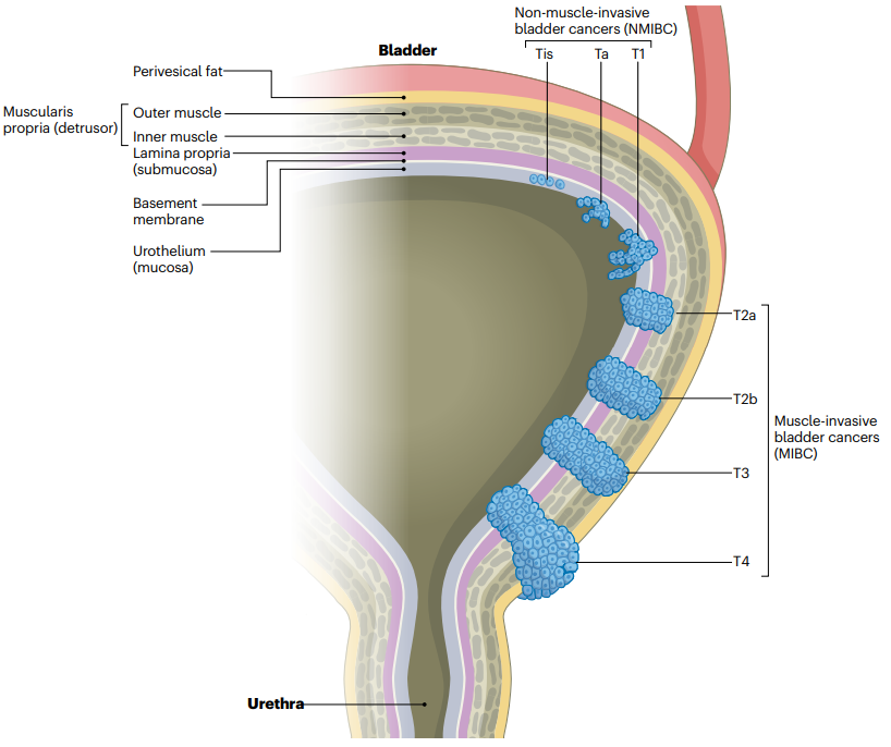 NatRevClinOncol's tweet photo. In a new Review now live online, Lambertus Kiemeney at co-authors discuss 'Global trends in the epidemiology of bladder cancer: challenges for public health and clinical practice' https://t.co/Xeq3WhbW9E #blcsm #hsronc #caepid https://t.co/Lp595lsyLM