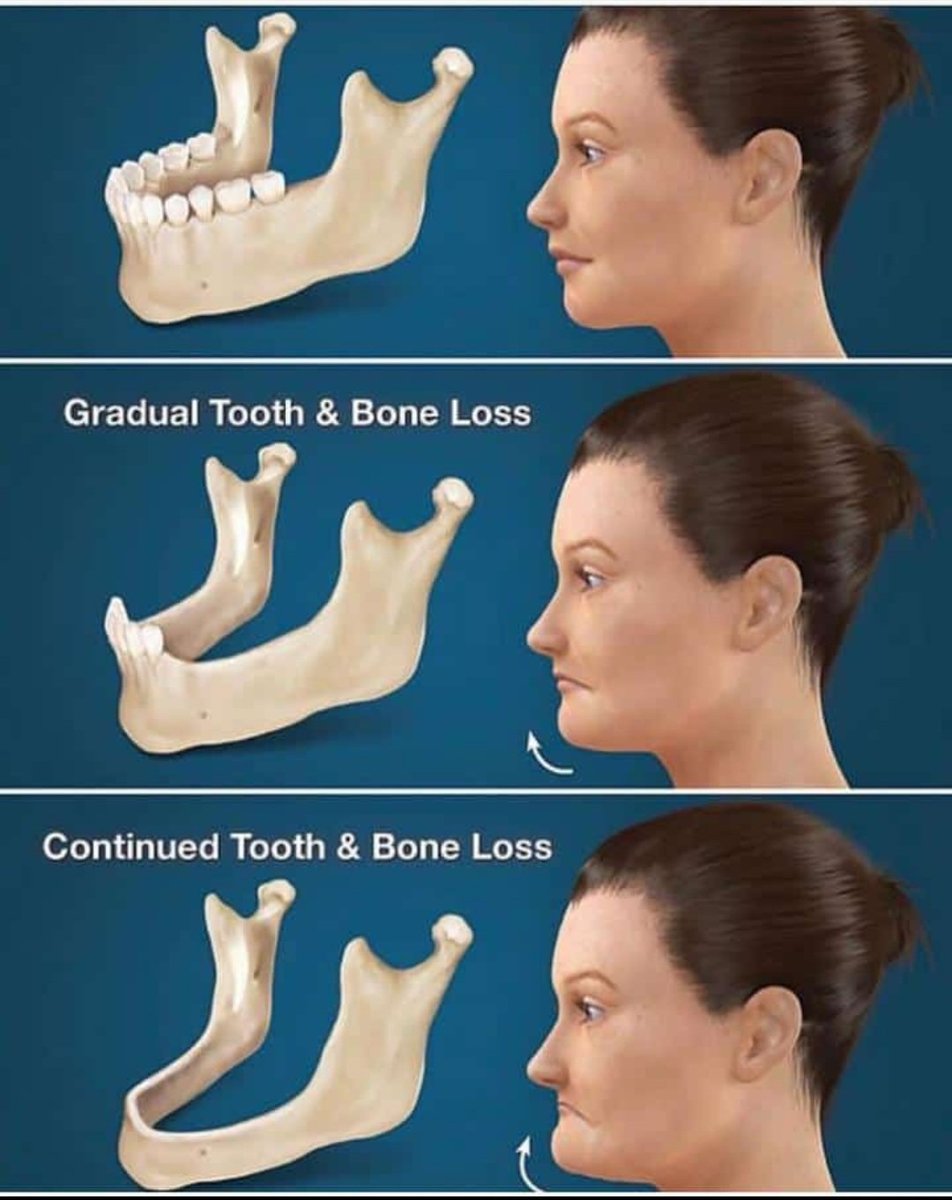 JamenyDental's tweet photo. Let's try to avoid removing our teeth if we can help it😊 
Visit a dentist for check up ,save your teeth!

#JamenyDentalSurgery 
#saveyourteeth https://t.co/5p5uOYqiGj