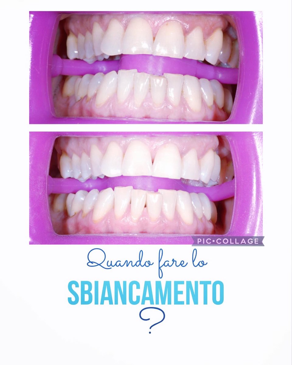 r_monguzzi's tweet photo. 👄 Lo sbiancamento dentale è un trattamento estetico mirato a correggere eventuali discromie causate da abitudini come il fumo di sigaretta, assunzione di bevande scure come thé, caffè, tornando alla tonalità più chiara dei propri denti. 
Chiamaci ☎️ 0226145657 📱 3888402092 https://t.co/rnX30tGTHk