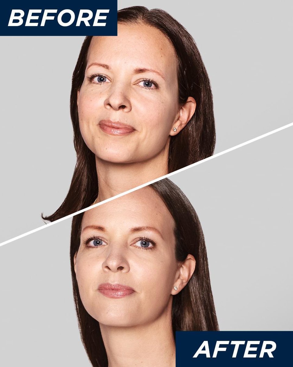abmmedical's tweet photo. Medical Clinic in Woodland Hills serving all of the Los Angeles area. Your skin will be less wrinkled 15 months after a Restylane® Skinboosters™ treatment.
#Restylane #fillerinjections #scienceofskin #aesthetictreatments #GetYourGlowOn https://t.co/yZb8tiCnTw
