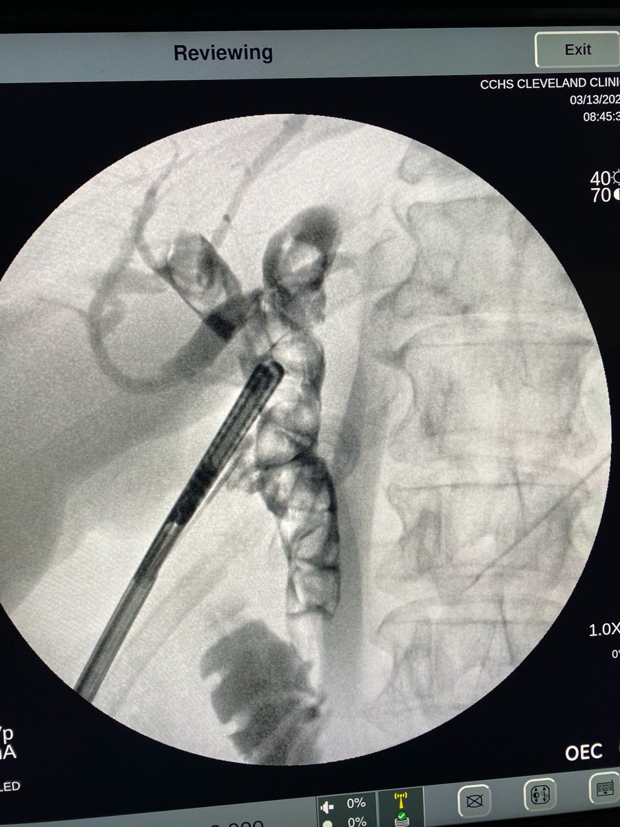 A great finding on an afternoon cholecystectomy. What would you do?