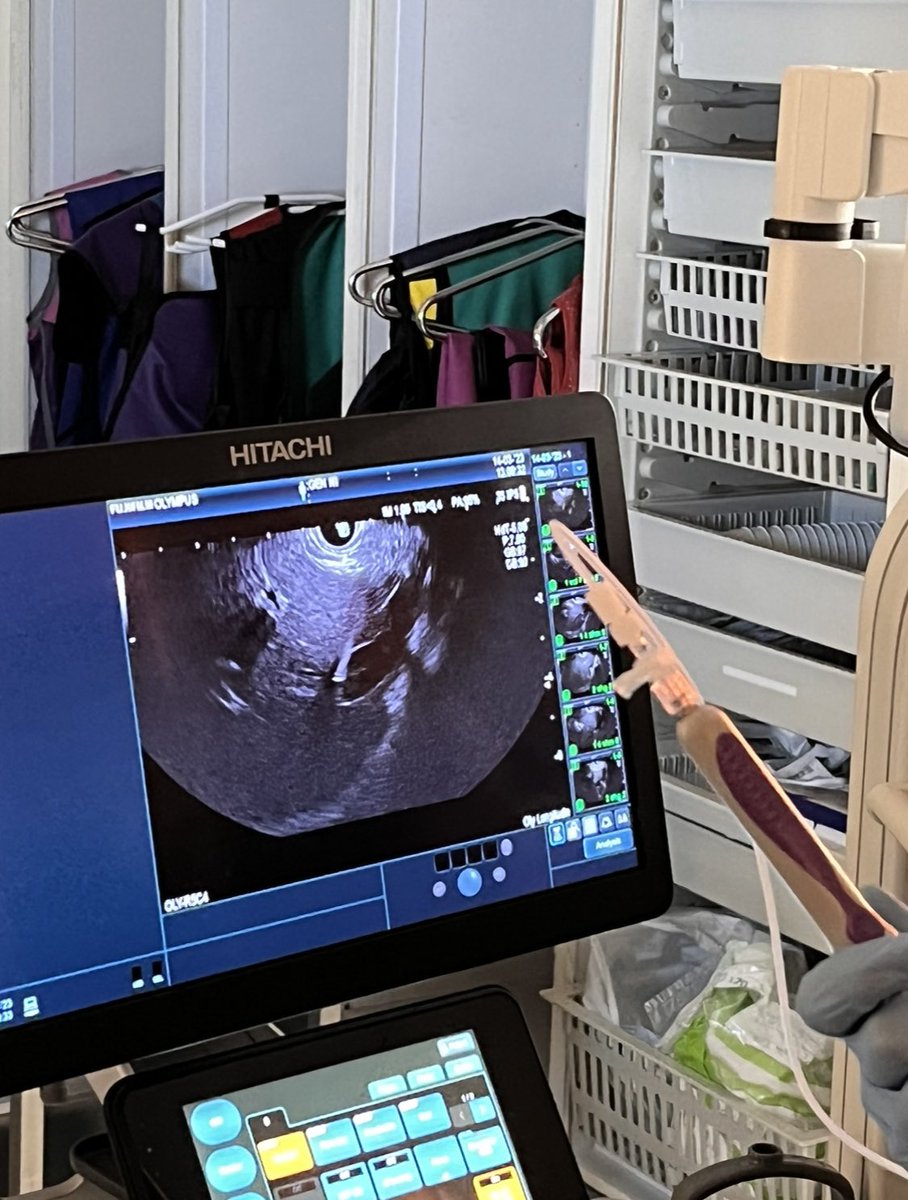 AymericBecq's tweet photo. First case of EUS guided portal pressure gradient measurement @GHUMondor ! Thanx @Cookgastro @CookMedical for the help and guidance. 
#endoscopy #liverdisease #eus https://t.co/wLdgm7LuRE