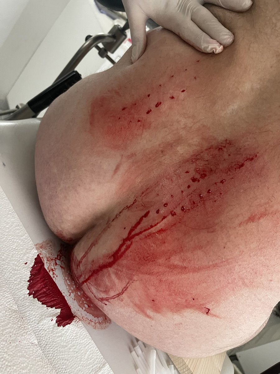 RebellleFleur's tweet photo. Da schlägt mein kleines sadistisches herz 💕 

Habe diesen Sklaven seit ungefähr 10 Jahren und heute bekam er endlich sein Branding und habe ihn markiert - wer will es sehen? 😮‍💨😋🤤

Nun gehörst du für immer mir! https://t.co/KISGVdF3HU