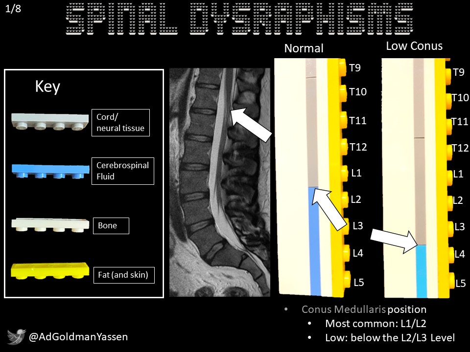 First attempt at Tweetotial! I was limited by the #LEGOs my children had.

Spinal dysraphisms are classified:
-Open➡️Skin defect
-Closed (with or without subcutaneous mass) ➡️Skin covered 

@LEGO_Group #LEGOneurorads #MedEd 
Some images via @Radiopaedia