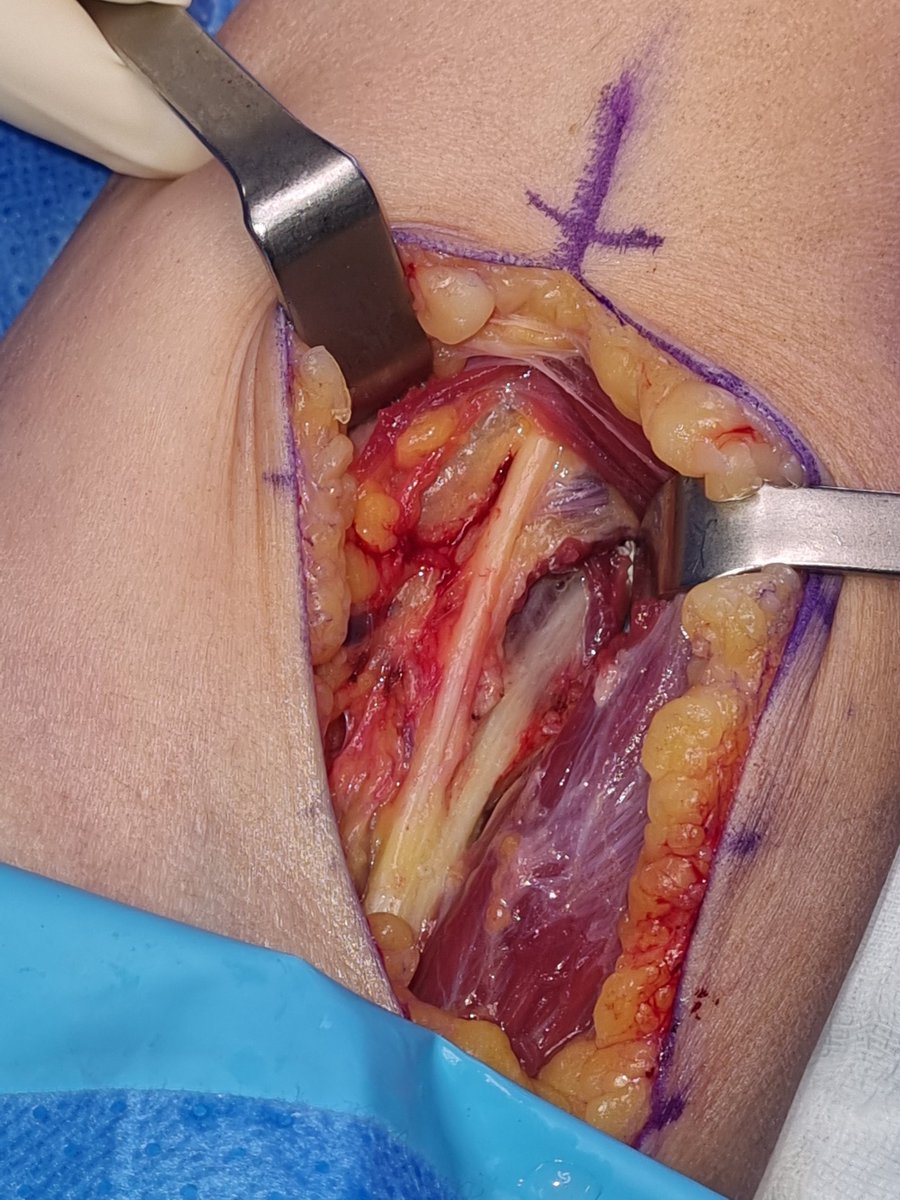 ➡️ Atrapamiento nervio interóseo posterior en arcada de Frohse 
⏩️ EMG frecuentemente negativa
☑️ Diagnóstico clínico si EMG -
👍 Tto: apertura de la arcada
#ServicioCOTDrSanchezAlepuz 
<a href="/IMEDHospitales/">IMED Hospitales</a> Valencia