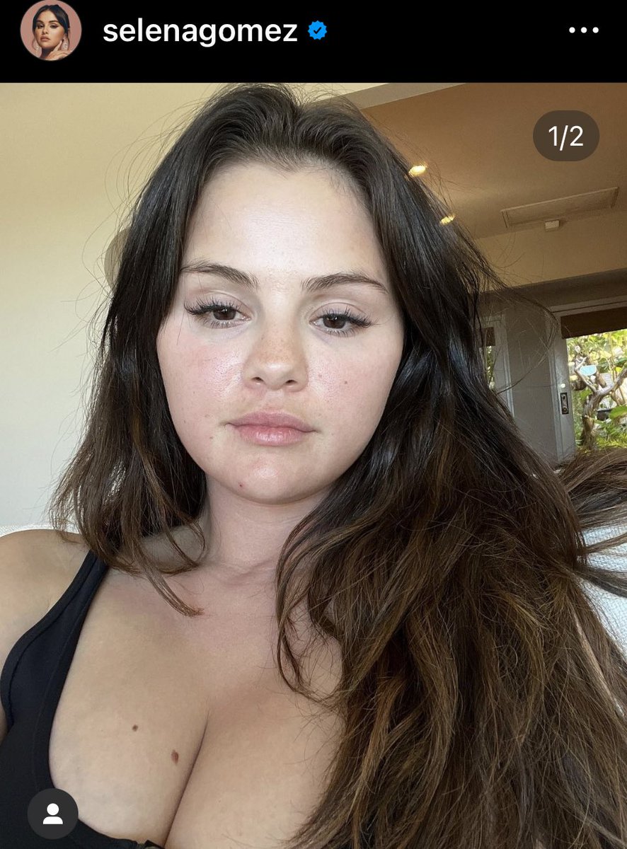 Aprovechemos esa foto Selena para hablar rápidamente del LES Renal 

Si eres Reuma o Nefro, este post no es para ti, seguro ya te sabes todo. ✅