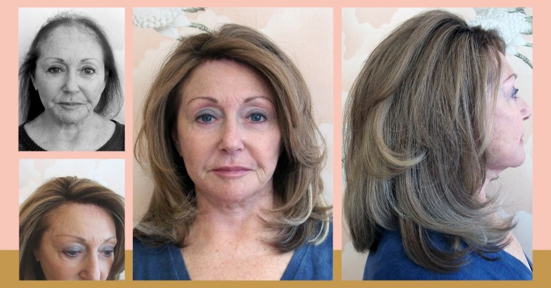 HairSolved's tweet image. What makes the Enhancer System so unique? 
It is so NATURAL

We use a light, flexible mesh directly on the scalp, along with 100% real hair to create the look and feel of natural, beautiful hair.

#meshintegrationsystem #hairsystem 
#hairlosspecialist #hairreplacementsystem