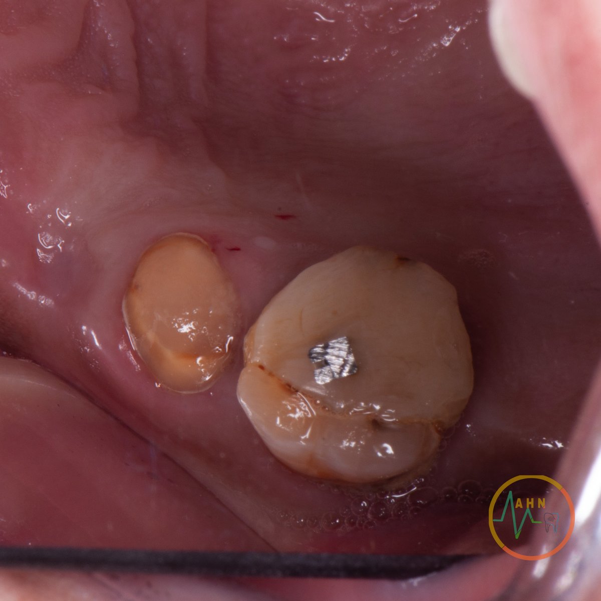 dentist_amar617's tweet photo. إعادة الحياة لسن باعادةعلاج العصب ومتبوع بحشوة ووتد تجهيزا للتلبيسة
Re RCT for #25 diagosed as previously endo tereated with apical periodonditis
obturated by GP and bioceramic sealer Then built up by composite and post
#endodontics #dentistryworld #saveatooth
#new_challenge https://t.co/47VKrjIVj2