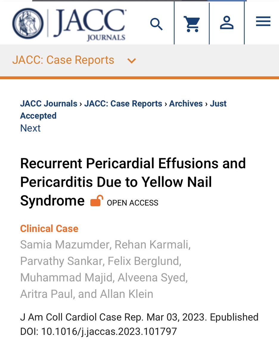 Samia Mazumder, MD (@mazumders_md) on Twitter photo Check out our new case in <a href="/JACCJournals/">JACC Journals</a>, recurrent pericardial effusions in the setting of YNS! Thanks to this amazing team and phenomenal mentorship by <a href="/AllanLKleinMD1/">Allan L. Klein</a> <a href="/RehanKarmaliDO/">Rehan Karmali DO, MS</a> <a href="/DocMajid/">Muhammad Majid</a> <a href="/parvsan1/">Parvathy Sankar, DO</a> <a href="/BerglundMd/">Felix Berglund</a> <a href="/Syed_Alveena/">Alveena Batool Syed</a> jacc.org/doi/10.1016/j.… Check out our new case in <a href="/JACCJournals/">JACC Journals</a>, recurrent pericardial effusions in the setting of YNS! Thanks to this amazing team and phenomenal mentorship by <a href="/AllanLKleinMD1/">Allan L. Klein</a> <a href="/RehanKarmaliDO/">Rehan Karmali DO, MS</a> <a href="/DocMajid/">Muhammad Majid</a> <a href="/parvsan1/">Parvathy Sankar, DO</a> <a href="/BerglundMd/">Felix Berglund</a> <a href="/Syed_Alveena/">Alveena Batool Syed</a> jacc.org/doi/10.1016/j.…