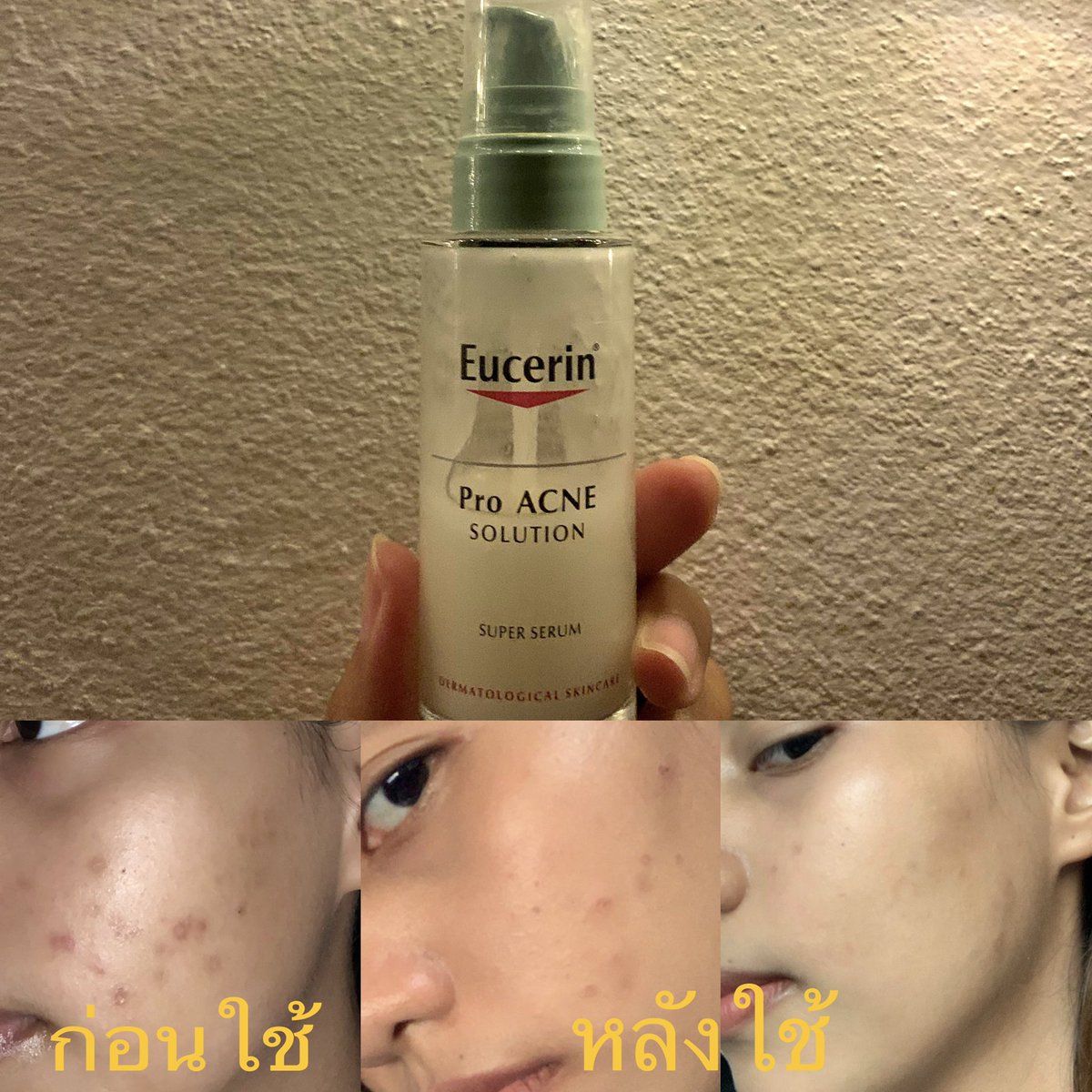 nonononononofav's tweet photo. อยากแนะนำตัวpro acne super serumหลังจากที่แอบไปใช้มาระยะนึง(ครึ่งขวดแรก)หนึ่งเลยคือสิวอุดตันเราลดลง ไม่เกิดสิวใหม่ซ้ำๆแล้ว แอบรู้สึกว่าน้องตัวนี้ช่วยเรื่องรอยดำด้วย และที่เด็ดเลยคือร่องรูขุมขนบริเวณข้างจมูกเราตื้นขึ้น ส่วนตัวเราคิดว่าสมราคาเลยแหละ  #รีวิวEucerin https://t.co/McjPoRR37X