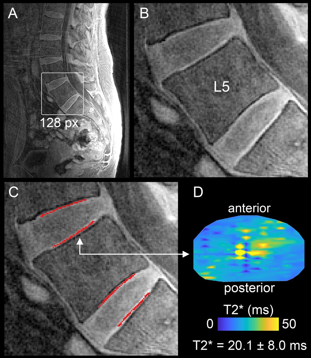 Deficits in cartilage endplate (CEP) health measured w/ UTE MRI have been linked to disc degeneration, but subjective CEP identification limits biomarker reliability. We’ve developed software (free!) for accurate/efficient ID of the CEP on UTE images. doi.org/10.21037/qims-…