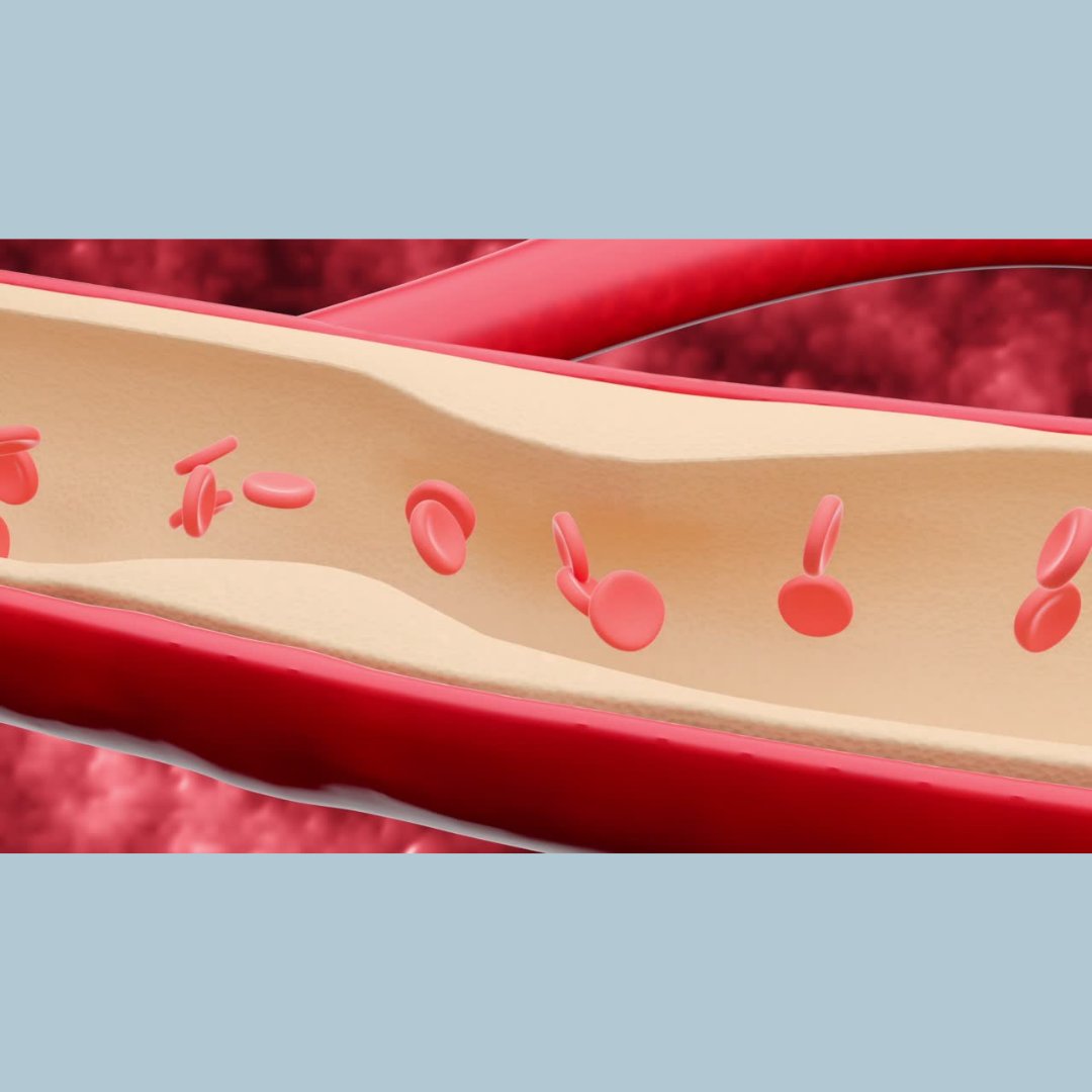 Cholesterol can form a deposit on the inside of the arteries. This can narrow the arteries and make them less flexible. If it ruptures and breaks apart, a blood clot forms and blocks one of these narrowed arteries. causing a heart attack or stroke.

heart.org/en/health-topi…