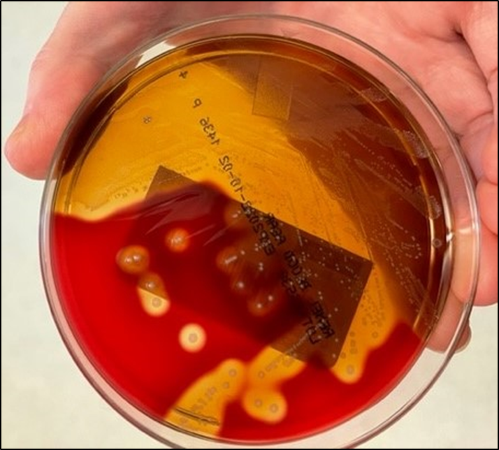 DHPathRes's tweet photo. Time for #microrounds 

What is the type of hemolysis seen in the agar plate? Can you mention the differential diagnosis of bacteria that can look like this?

Left: Gram stain
Right: Sheep's blood agar

#DHPath https://t.co/LyRezfPUUi