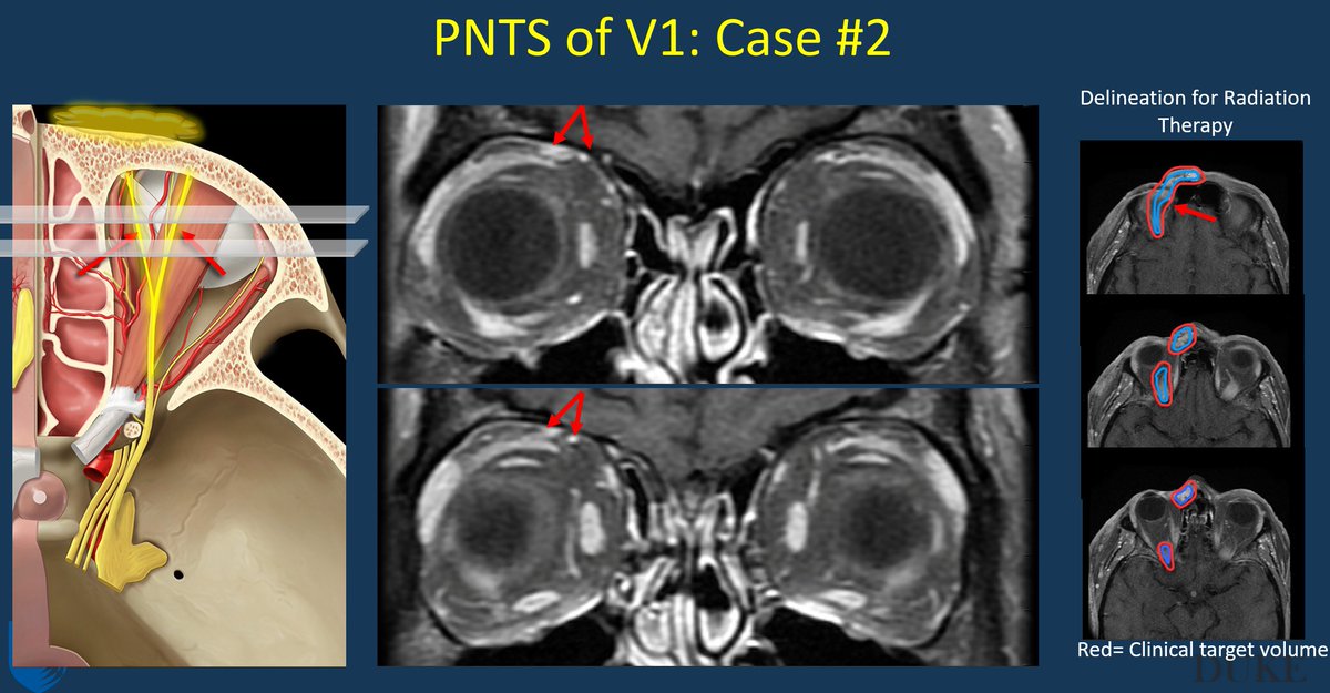rhwiggins's tweet photo. @PhilipRChapman1 from @DukeRadiology gives great #UHNIC23 discussion on #PNTS #UUHNICE https://t.co/xMIdYs3Zqw