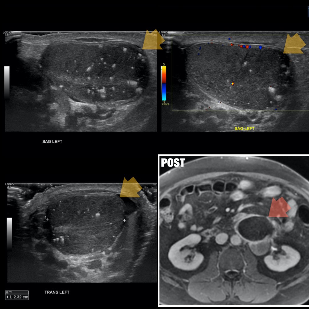 danatsouza's tweet photo. Scrotal pearls for @futureradres: testicular microlithiasis (>5 nonshadowing echogenic <3 mm foci per US image) a/w increased incidence of testicular cancer. In this case, with RP LN metastasis! @BrighamRad @AURtweet @FOAMrad @SAR_RFS @HarvardMacy @CBRadiologia #MedEd https://t.co/oHf0NNRX9Q