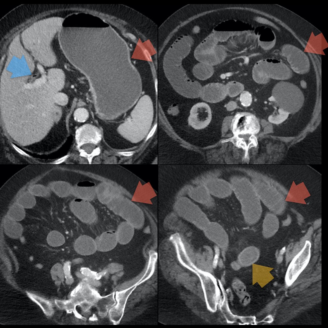 80-year-old female with pneumobilia (blue) + SBO (red) + large obstructing gallstone in the distal ileum (yellow) = Rigler's triad in gallstone ileus! Another Abdominal Radiology favorite! @BrighamRad @AURtweet @FOAMrad @SAR_RFS @futureradres @HarvardMacy @CBRadiologia #MedEd
