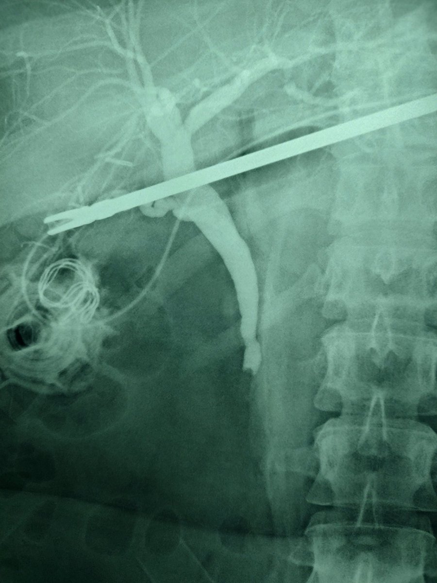 ralatorreadame's tweet photo. Semana pasada de dos pancreatitis biliares resueltas 
Con bilirrubinas normales 
Dos colecistectomias + cto por laparoscopia
Litos en ambas
La colangiografia tarda unos minutos y tiene grandes beneficios en los pacientes. https://t.co/eRRaI447Xz