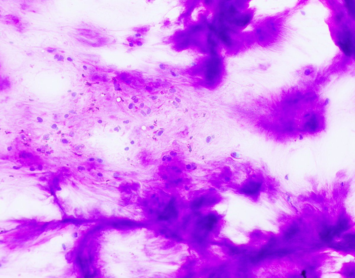 HubertLauMD's tweet image. I don&apos;t think I&apos;ll ever get tired of seeing this! #FNApath #CytoPath #ENTpath
