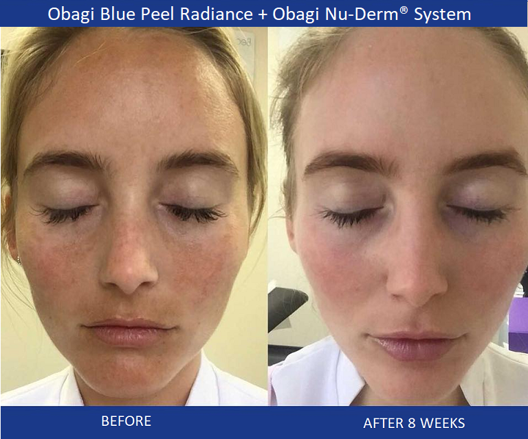 A 12-week course of Obagi Blue Radiance Peel and Obagi Nu-Derm System. 🤩

🔹Pigmentation/Skin Discoloration
🔹Acne Scarring 
🔹Fine Lines and Wrinkles 
🔹Melasma

Call 602-952-8446 to schedule a free consultation. 
 suddenlyslimmer.com/obagi-blue-rad…
.
.
.
.
.
.
#obagi #phoenix #phoenixaz