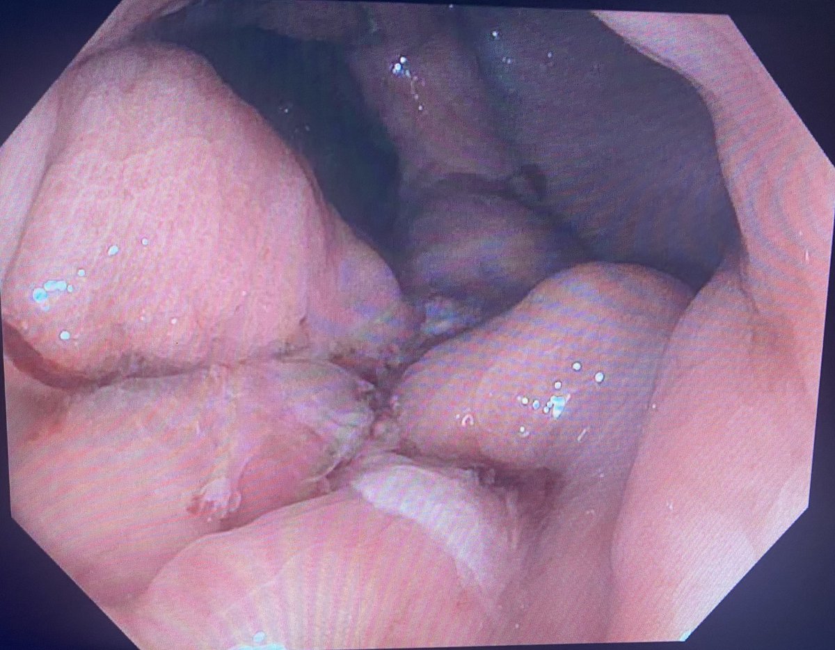 A very rewarding case of EDGE in patient with acute severe pancreatitis, pancreatico-pleural fistula, ERP with stenting for PD leak, resolution of leak, removal of PD stent, and endoscopic closure of gastro-gastric fistula. Happy patient, happy endoscopist for excellent outcome.