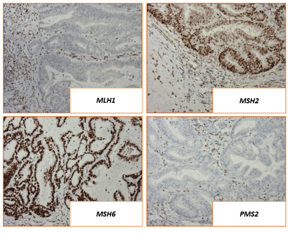 IHC result with absence of MLH1 &amp; PMS2. Possible explanations include (most likely to least):
1. MLH1 promoter hypermethylation
2. Double somatic MLH1 mutations
3. Lynch syndrome
All other abnormal IHC findings in CRC are more likely LS than DS. #ColorectalCancerAwarenessMonth