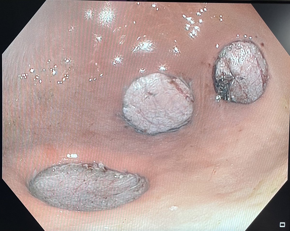 Shameless plug for <a href="/UTSWGI/">UTSW Gastroenterology Fellowship</a> to show my appreciation of their support in 3rd space endo. In addition to having me join cases w/ our current 3rd space faculty, last week we held our 2nd live pig lab of 2023. My ‘pt’ did great through 3 gastric ESDs, 2 esophageal ESDs, and a Z-POEM😃
