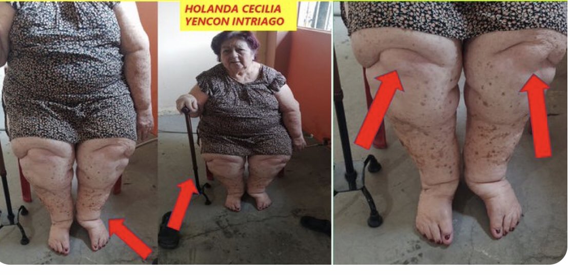 UniversidadDeG3's tweet photo. La Sra. Holanda Cecilia Yencon Intriago, trabajo 38 años en la @UdeGuayaquil. Ud @PacoRector decide suspender la jubilación complementaria, la Sra necesita comprar sus medicinas. Mientras usted decide eso, Abigail Manzo Nazate, q tiene carnet falso de discapacidad viva la fiesta. https://t.co/4SZ4iSB6cY