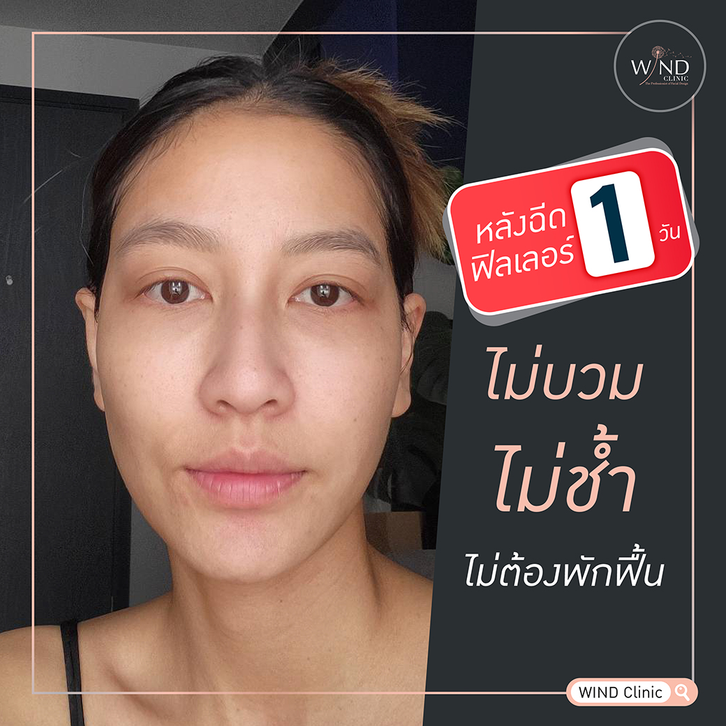 windclinic's tweet photo. เติมให้เต็ม เด็กลง 1000%
#Filler เติมเต็มเห็นผลหลังทำทันที ไม่บวมไม่ช้ำ
รูปหน้าเป๊ะ กังวัลจุดไหน แก้ไขได้ทุกจุด
#Filler #WINDCLINIC https://t.co/OlGzZ6wXBK