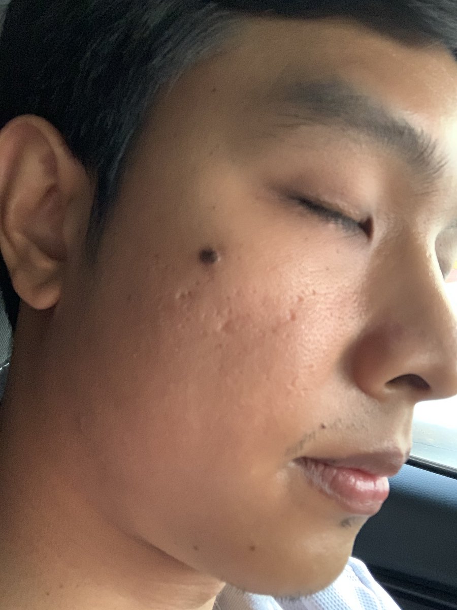BoVannavat's tweet photo. ปกติเป็นคนหน้ามันผิวแพ้ง่าย ทำให้สิวขึ้นง่ายด้วย แต่หลังจากใช้เจลตัวนี้ทำให้ผิวหน้าดีขึ้น สิวยุบไว และไม่ระคายเคืองต่อผิวเลยใช้ดีมากๆ https://t.co/6Jflvy5Lxe