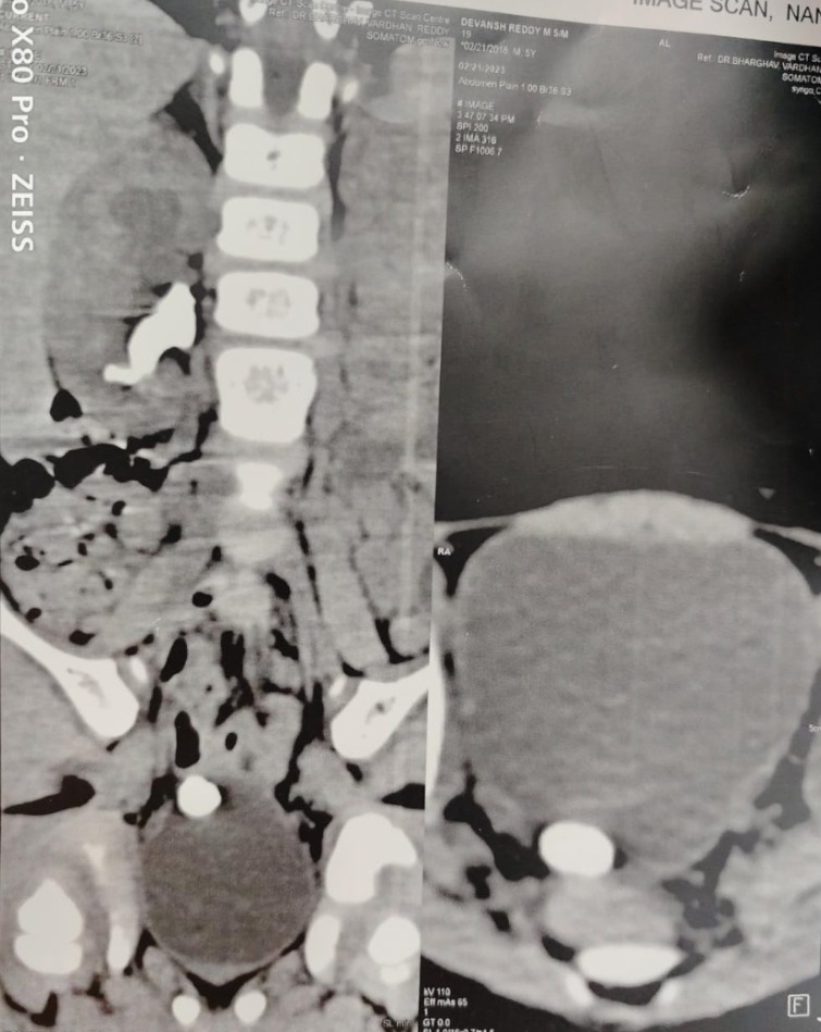 DrVCMohan's tweet photo. https://t.co/yXo5I7KZwh

Small male Child  4 years with #bladderstone and partial staghorn stone. 
#Cystolitho with 7.5 fr nephro scope 
And #supinePCNL. 
Video focussed on laser setting #TFL.
#Pediatricbladderstone
#pediatricstaghornstone @usioffice @AmerUrological @Uroweb @endouroacademy @Endo_Society @preetihospital