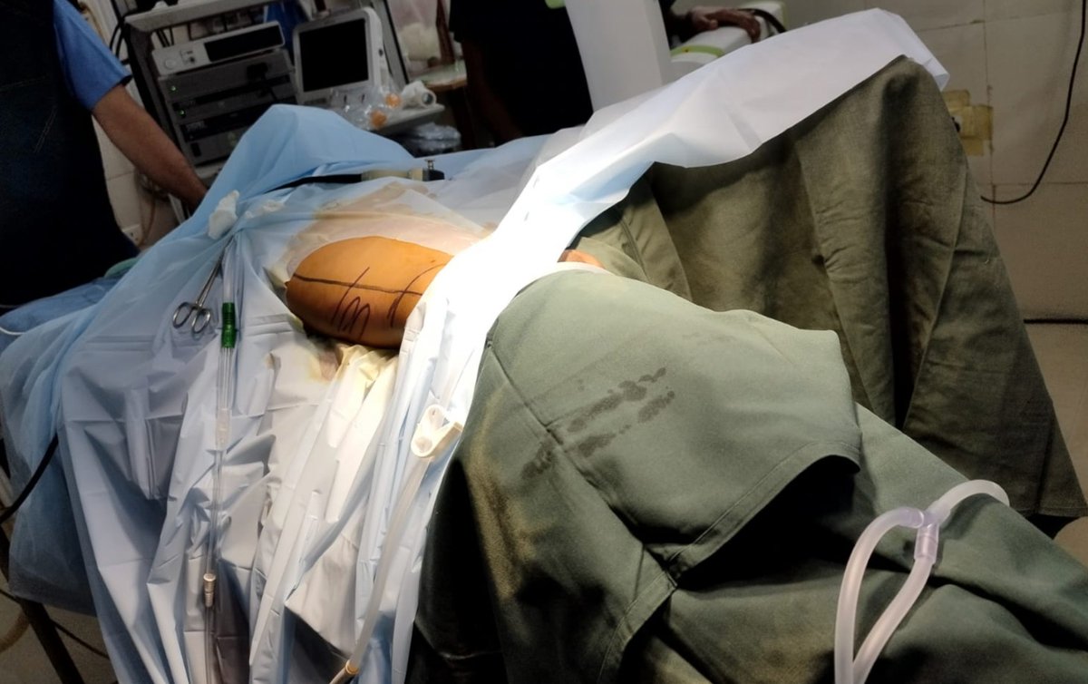 DrVCMohan's tweet photo. https://t.co/yXo5I7KZwh

Small male Child  4 years with #bladderstone and partial staghorn stone. 
#Cystolitho with 7.5 fr nephro scope 
And #supinePCNL. 
Video focussed on laser setting #TFL.
#Pediatricbladderstone
#pediatricstaghornstone @usioffice @AmerUrological @Uroweb @endouroacademy @Endo_Society @preetihospital