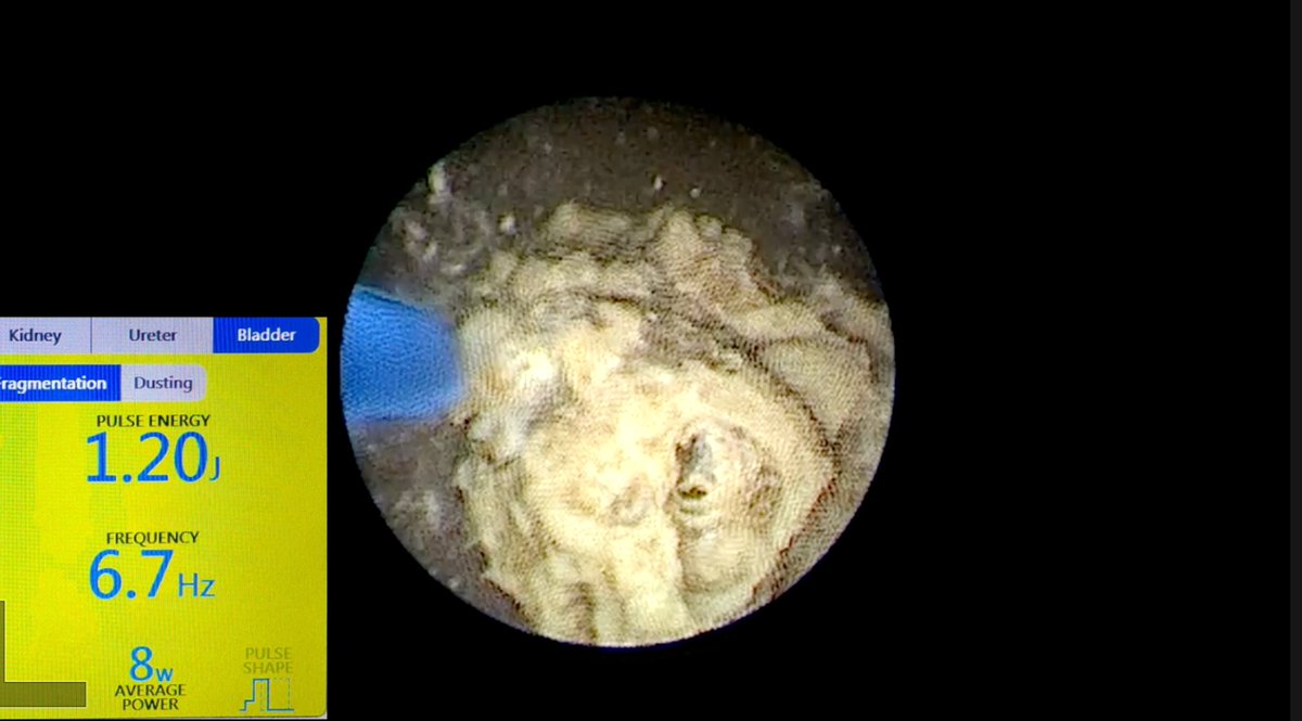 DrVCMohan's tweet photo. https://t.co/yXo5I7KZwh

Small male Child  4 years with #bladderstone and partial staghorn stone. 
#Cystolitho with 7.5 fr nephro scope 
And #supinePCNL. 
Video focussed on laser setting #TFL.
#Pediatricbladderstone
#pediatricstaghornstone @usioffice @AmerUrological @Uroweb @endouroacademy @Endo_Society @preetihospital