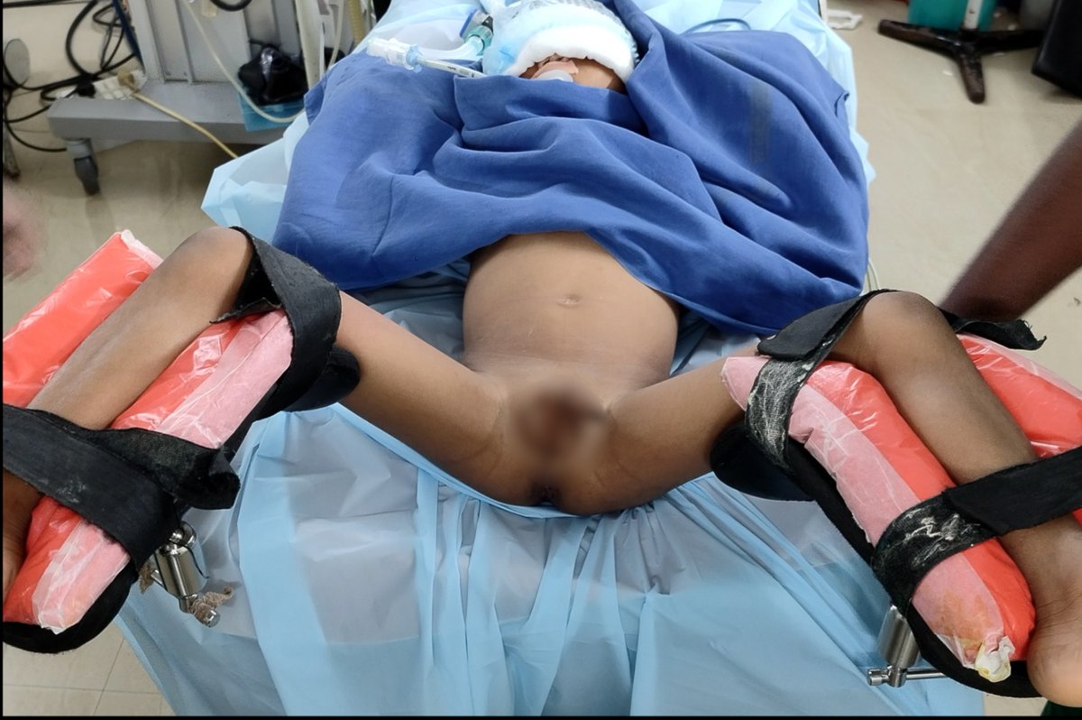 DrVCMohan's tweet photo. https://t.co/yXo5I7KZwh

Small male Child  4 years with #bladderstone and partial staghorn stone. 
#Cystolitho with 7.5 fr nephro scope 
And #supinePCNL. 
Video focussed on laser setting #TFL.
#Pediatricbladderstone
#pediatricstaghornstone @usioffice @AmerUrological @Uroweb @endouroacademy @Endo_Society @preetihospital