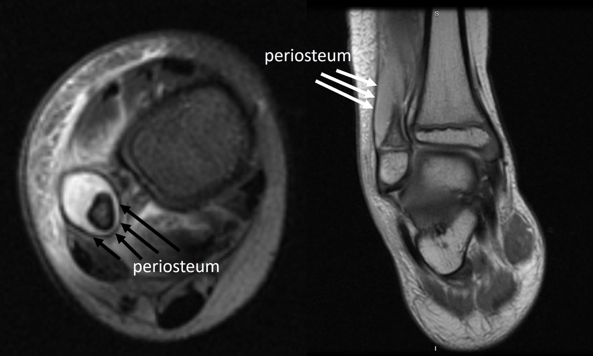 Osteomyelitis is a MEDICAL problem that should be treated by antibiotics. However, there are few indications for surgical debridement. One of them, is sub periosteal abscess collection. In this MRI you can see example of this collection #pediatricorthopedics #orthopedicsurgery