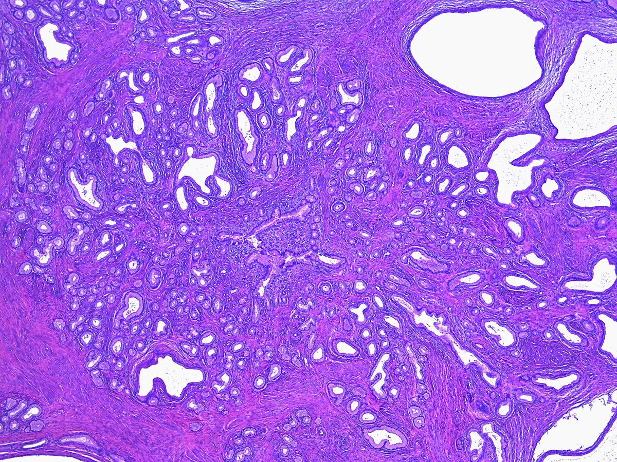 Pathology WalkerAuto Tweet Bot on Twitter "Lobular endocervical