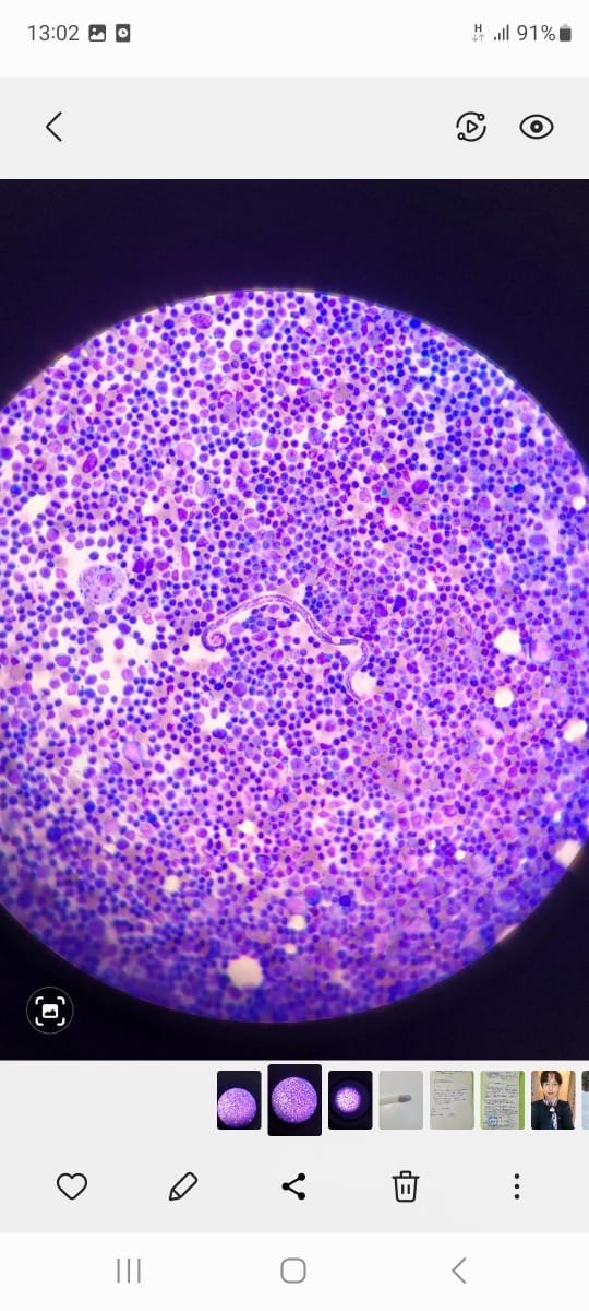 rep692's tweet image. Puncture of the cervical lymph node...