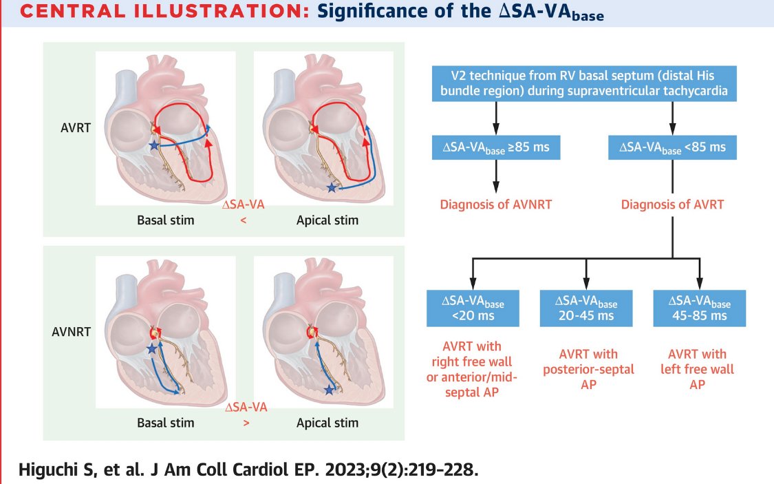 Kalyanam Shivkumar MD PhD (@shivkumarmd) on Twitter photo Deducing arrhythmia mechanisms...the joy of EP!! An elegant paper from <a href="/UCSF/">UC San Francisco</a> <a href="/UCSFHospitals/">UCSF Health</a> <a href="/UCSFMedicine/">UCSF School of Medicine</a> from Dr. Scheinman and colleagues from around the world. <a href="/JDMossMD/">Joshua Moss MD</a> <a href="/Ed_Gerst/">Edward Gerstenfeld</a> <a href="/gregorymmarcus/">Greg Marcus</a>
jacc.org/doi/10.1016/j.… Deducing arrhythmia mechanisms...the joy of EP!! An elegant paper from <a href="/UCSF/">UC San Francisco</a> <a href="/UCSFHospitals/">UCSF Health</a> <a href="/UCSFMedicine/">UCSF School of Medicine</a> from Dr. Scheinman and colleagues from around the world. <a href="/JDMossMD/">Joshua Moss MD</a> <a href="/Ed_Gerst/">Edward Gerstenfeld</a> <a href="/gregorymmarcus/">Greg Marcus</a>
jacc.org/doi/10.1016/j.…