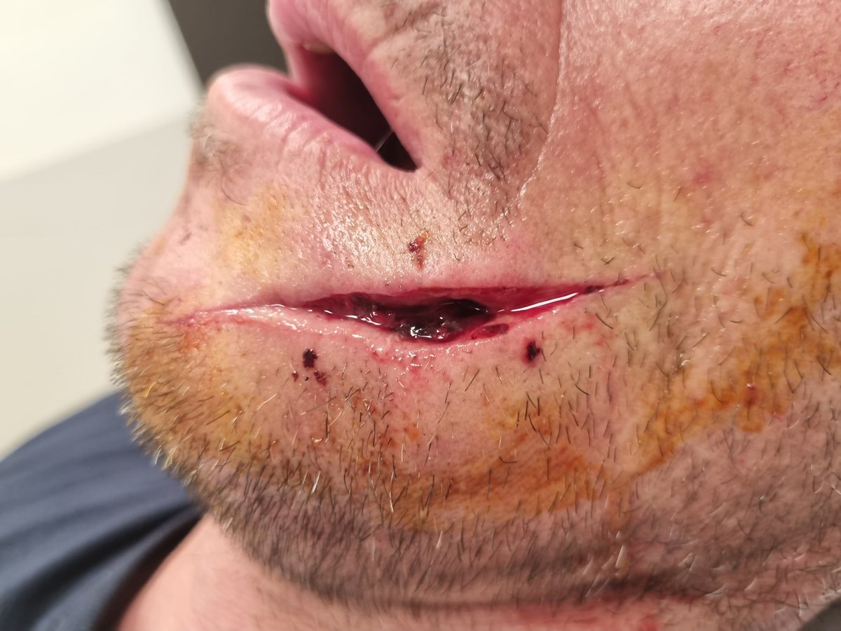Stevenn02924973's tweet photo. Gutless person slit my face in a home invasion a week ago this is so wrong I've been a victim for the second time in a home invasion in 2 years ..... https://t.co/zmxPv02Y6T