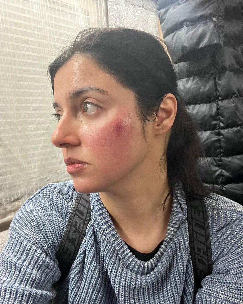Actor - Producer #DivyaKhoslaKumar got badly injured during an action sequence for her upcoming project.  She took to social media saying 'But the show must go on!'